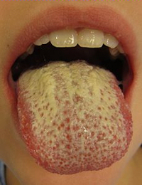 oral-candidiasis