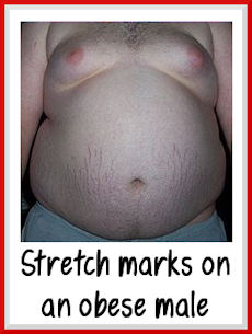stretch-marks